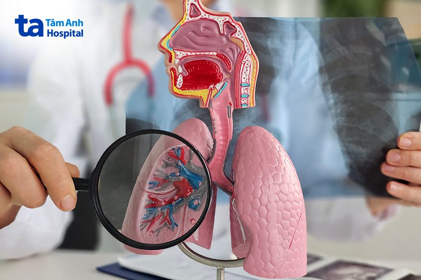 Bệnh mạn tính khiến dịch rò rỉ vào khoang màng phổi