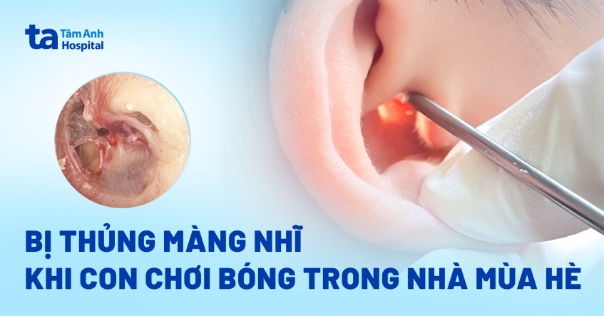 bị thủng màng nhĩ do va đậm