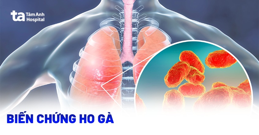 12 biến chứng ho gà có thể gặp phải, nguy hiểm cần lưu ý