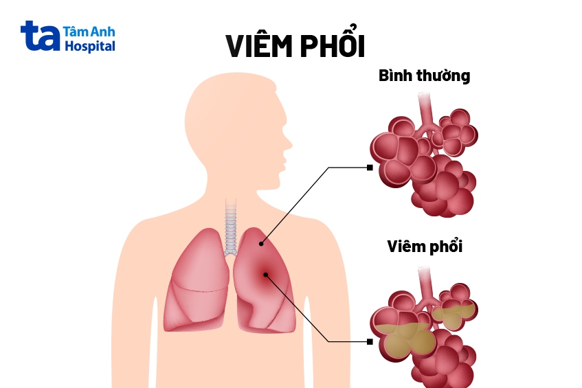 biến chứng viêm phổi do ho gà