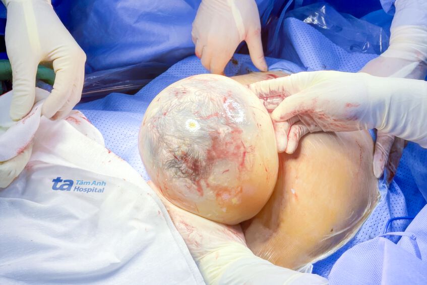 bọc ối còn nguyên vẹn