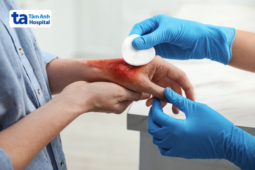 Bỏng là một chấn thương phổ biến