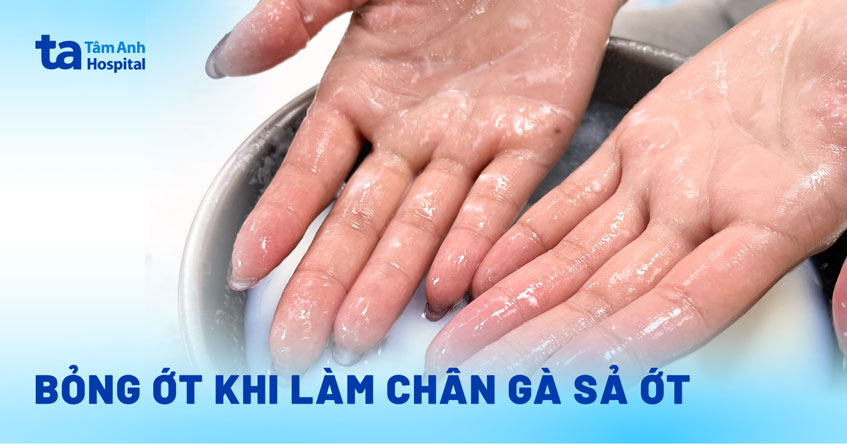 Bỏng ớt khi làm chân gà sả ớt