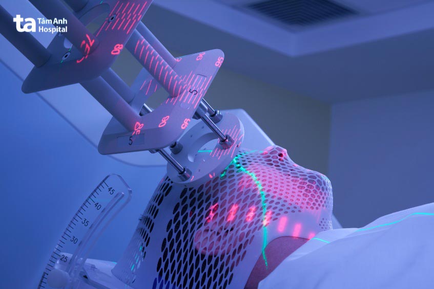 các kỹ thuật xạ trị tiên tiến hạn chế tác dụng phụ