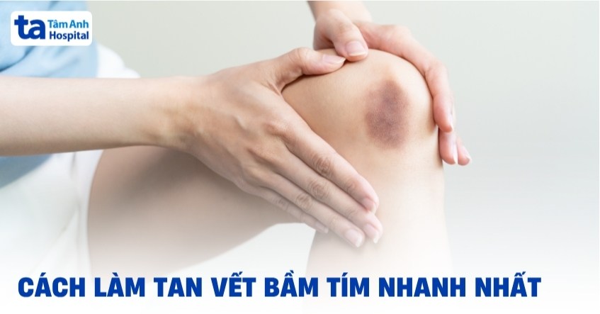 8 cách làm tan vết bầm tím nhanh nhất, điều trị an toàn, hiệu quả