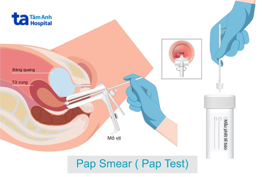 cách thức lấy mẫu trong xét nghiệm tầm soát