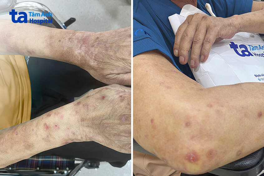 cải thiện sau 1 tuần tình trạng bệnh