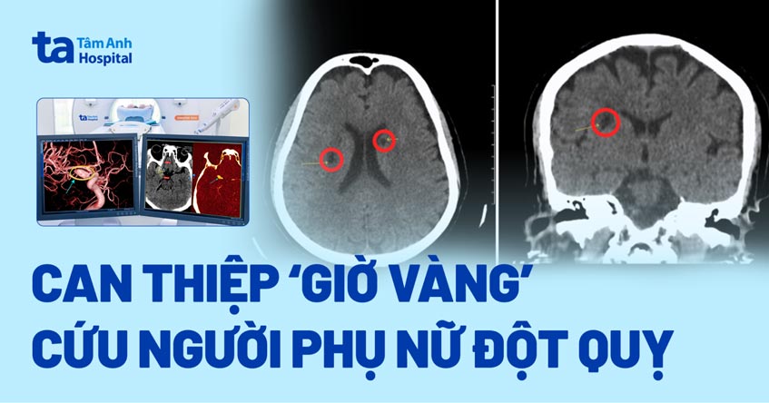 Can thiệp ‘giờ vàng’ cứu người phụ nữ đột quỵ