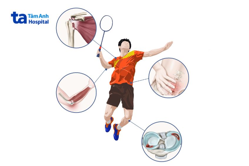 Cầu lông là môn thể thao dễ gặp chấn thương