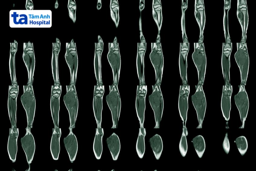 Chẩn đoán chấn thương vùng bắp bằng hình ảnh