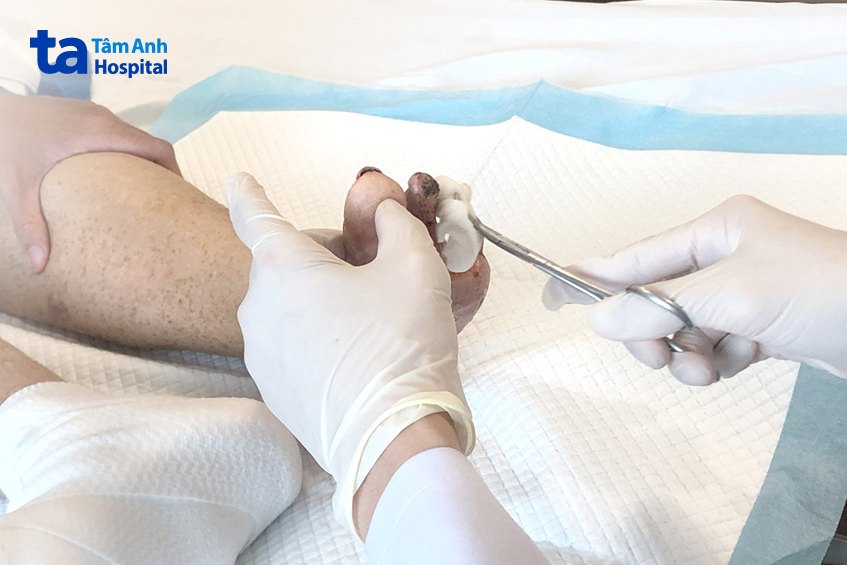 Chân trái người bệnh đã rụng 2 ngón