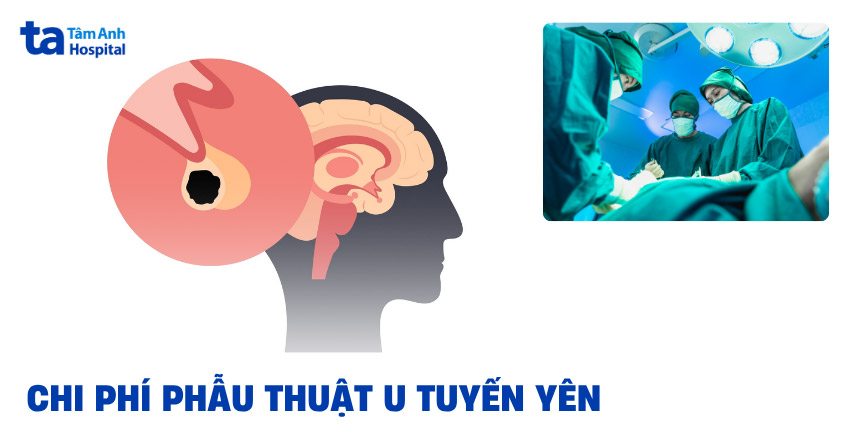 Chi phí phẫu thuật u tuyến yên bao nhiêu tiền? Yếu tố ảnh hưởng