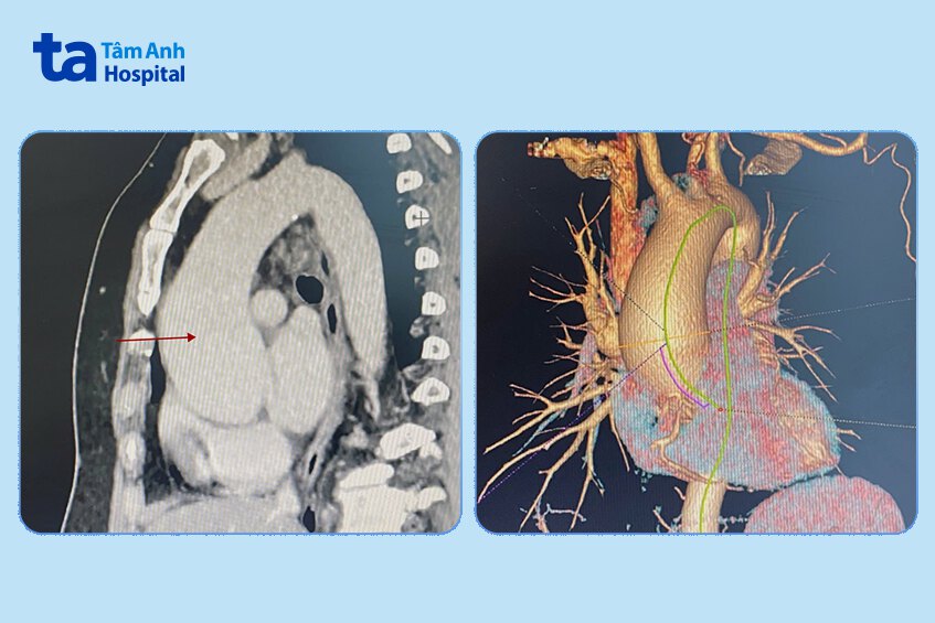 Chụp CT 1975 lát cắt cho thấy động mạch chủ ngực phình lớn