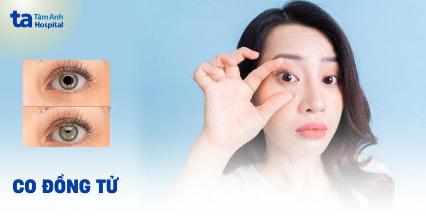 Co đồng tử là gì? Khi nào bị, triệu chứng, chẩn đoán và điều trị