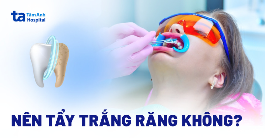 Có nên tẩy trắng răng không? Ai phù hợp và ai không nên làm?