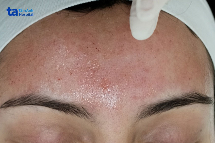 có nhiều vết thương hở khi lăn kim