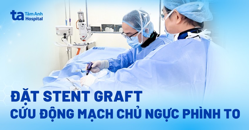 Đặt stent graft cứu động mạch chủ ngực phình to dọa vỡ