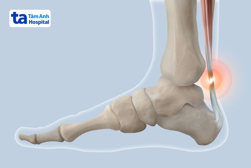 Đau dây Achilles khi chơi bóng rô