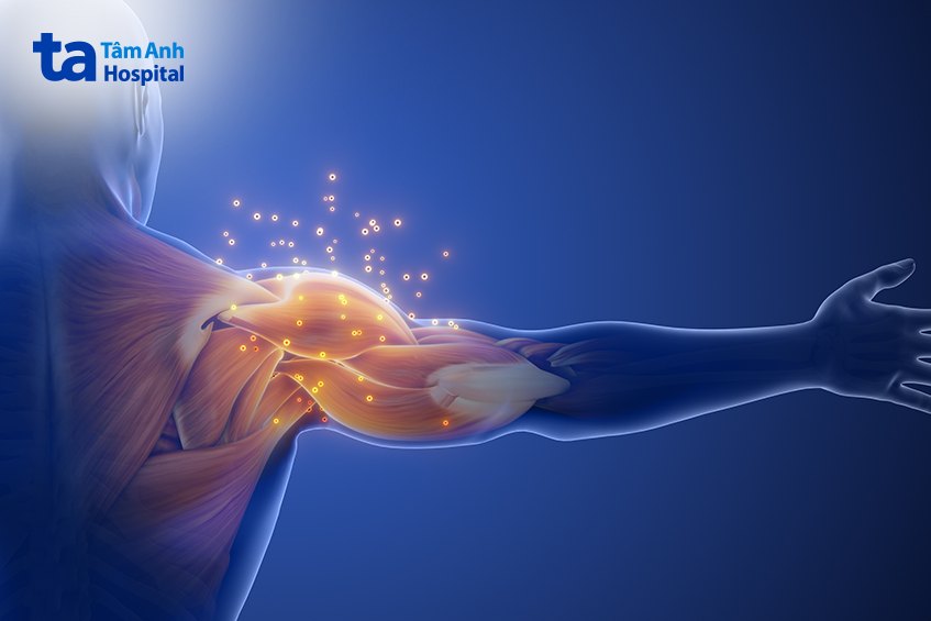 Cơn đau vùng vai bên phải thường xuất hiện bên trong khớp
