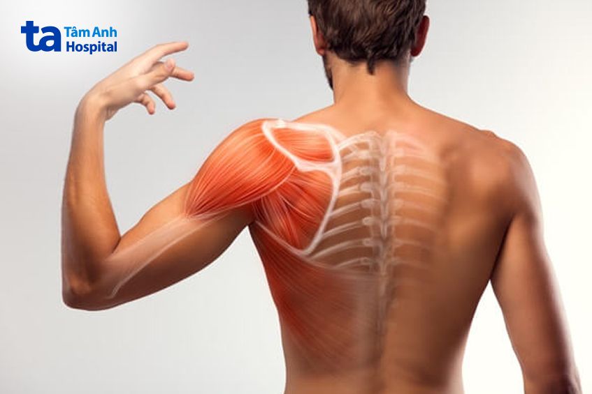 Đau khớp vai trái là gì?