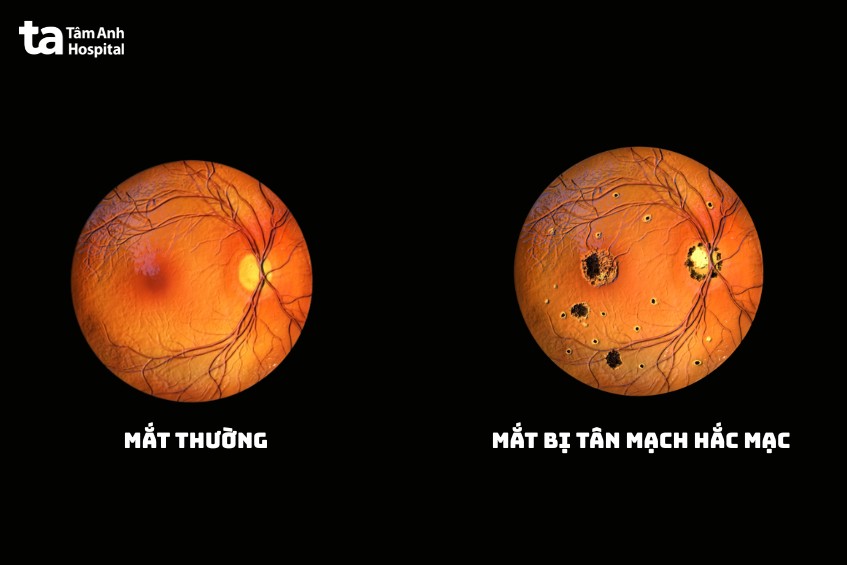 đáy mắt bị tân mạch hắc mạc