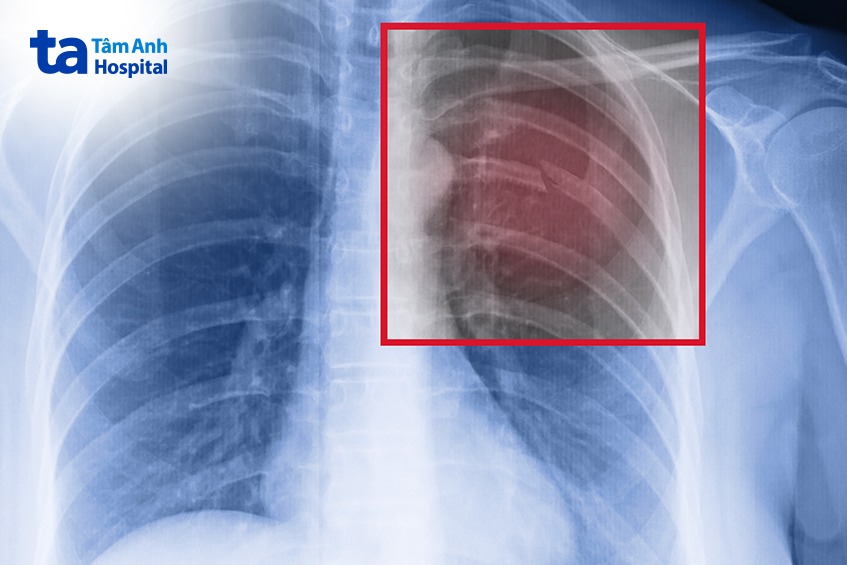 di chứng gãy xương sườn do ho gà