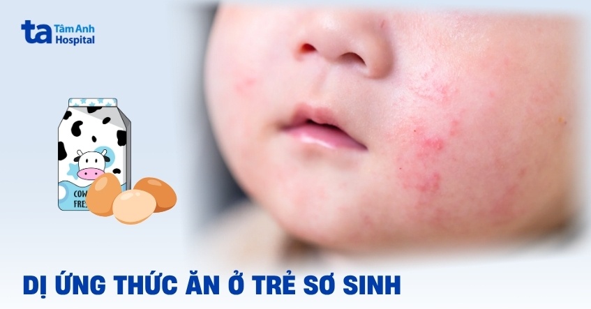 Dị ứng thức ăn ở trẻ sơ sinh phải làm sao? Dấu hiệu, nguyên nhân