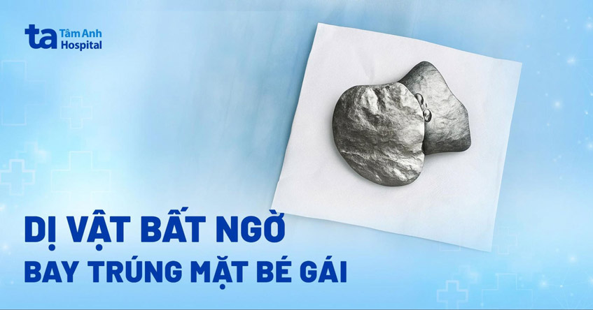 dị vật bất ngờ bay trúng mặt bé gái