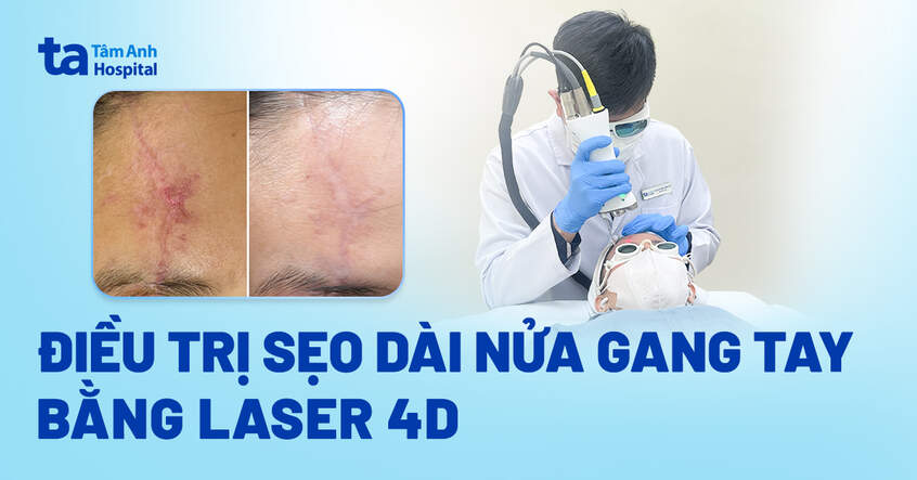 điều trị sẹo dài nửa gang tay bằng laser