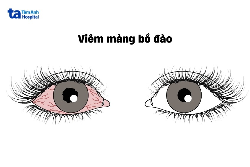 đỏ mắt là triệu chứng viêm màng bồ đào