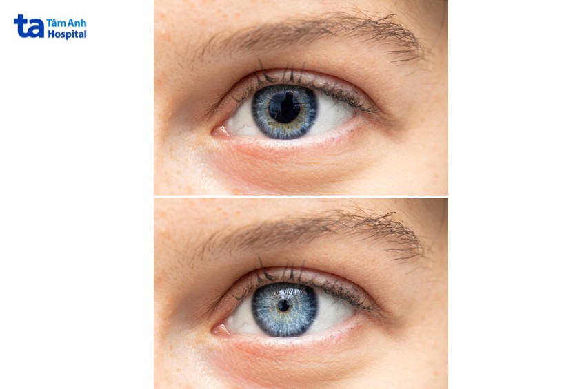 đồng tử co lại do nhiều bệnh