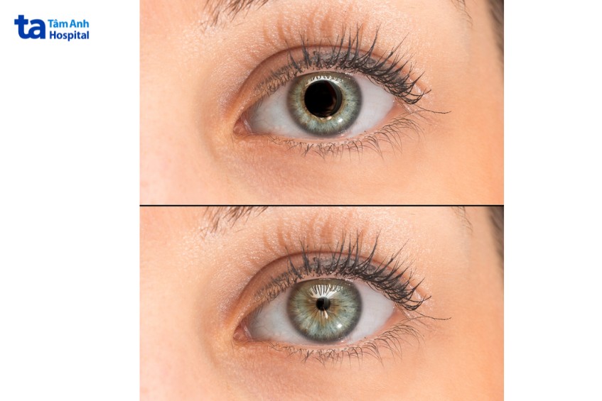 đồng tử có thể co 1 hoặc 2 mắt