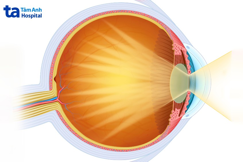 đục thể thủy tinh có thể gây mù