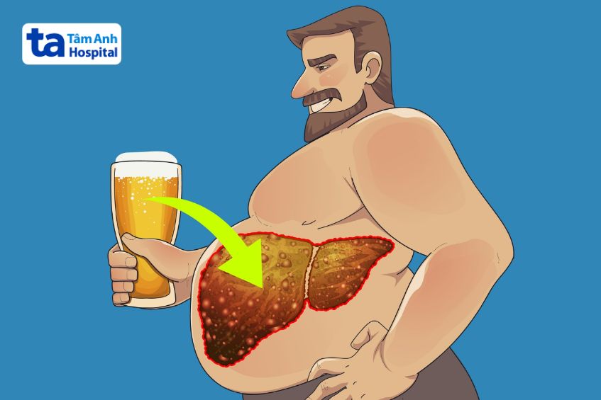 gan bị nhiễm mỡ do bia rượu