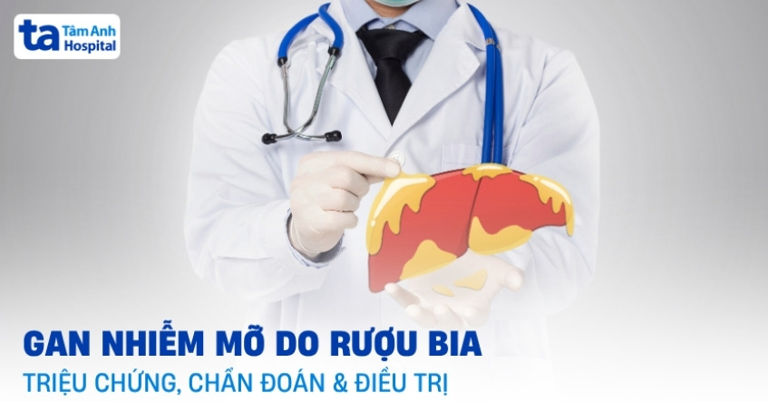 Bệnh gan nhiễm mỡ do rượu bia: Chẩn đoán và điều trị