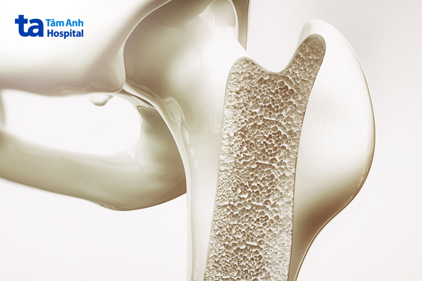 Nguyên nhân và yếu tố nguy cơ gây gãy xương do loãng xương