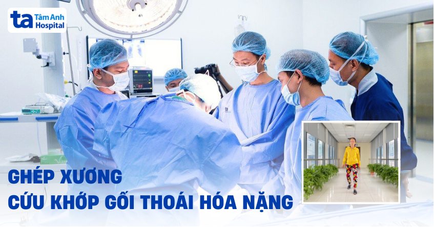 Ghép xương cứu khớp gối hỏng nặng