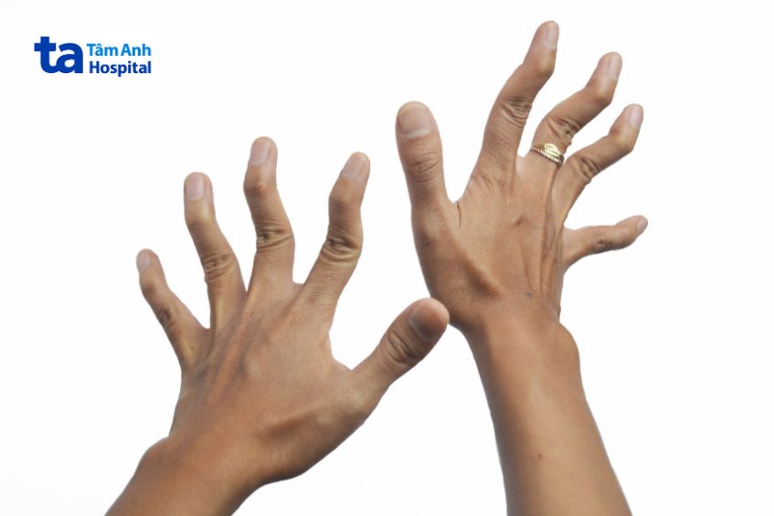 Giai đoạn tiến triển của viêm khớp dạng thấp