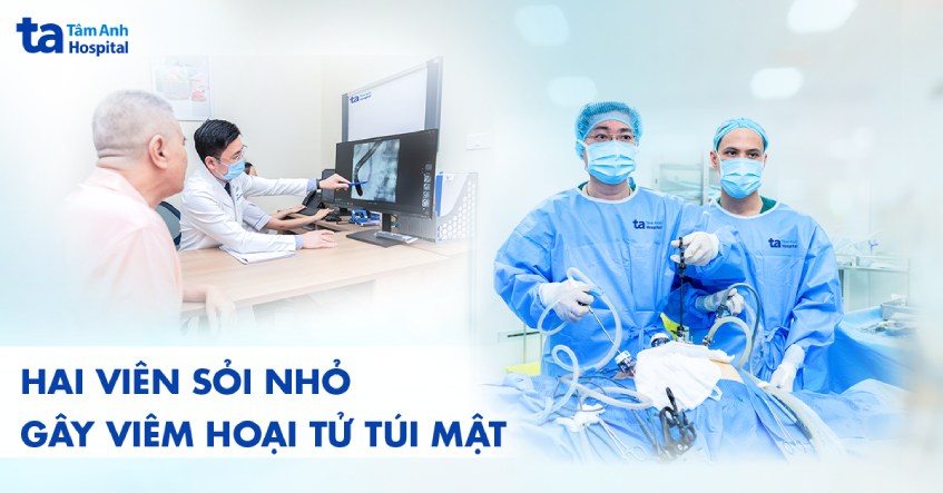 hai viên sỏi nhỏ gây viêm hoại tủ túi mật
