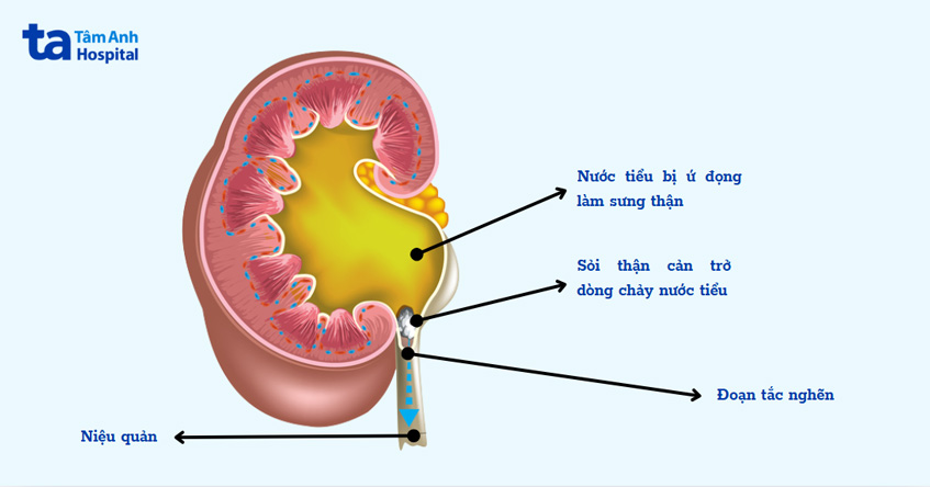 hậu quả của tắc nghẽn nghiêm trọng và kéo dài