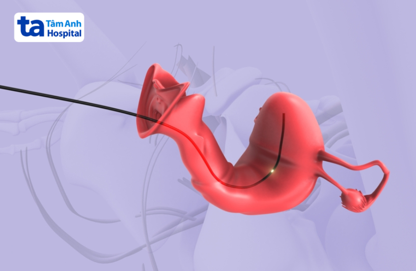 hình ảnh mô phỏng kỹ thuật xạ trị áp sát