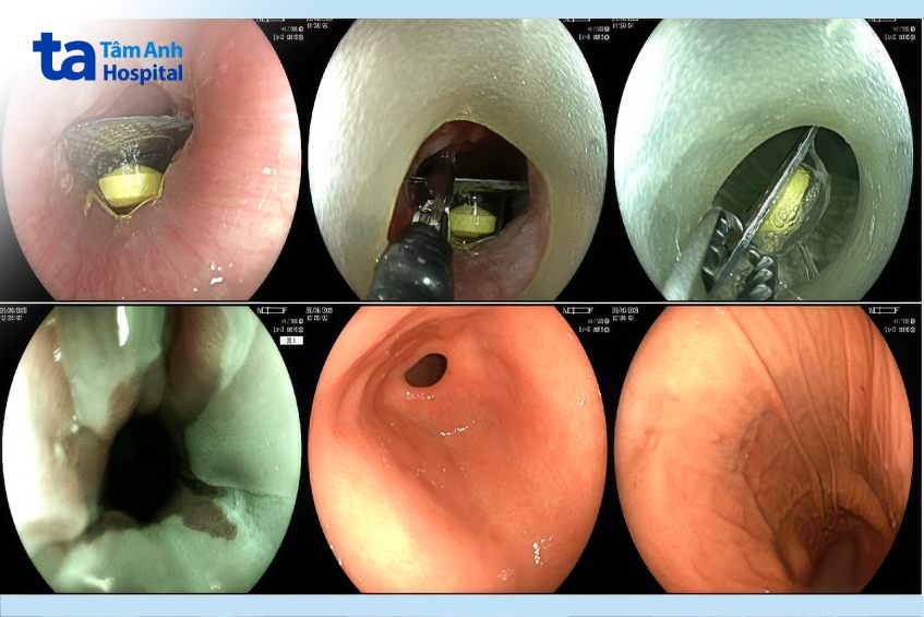 hình ảnh nội soi trong thực quản
