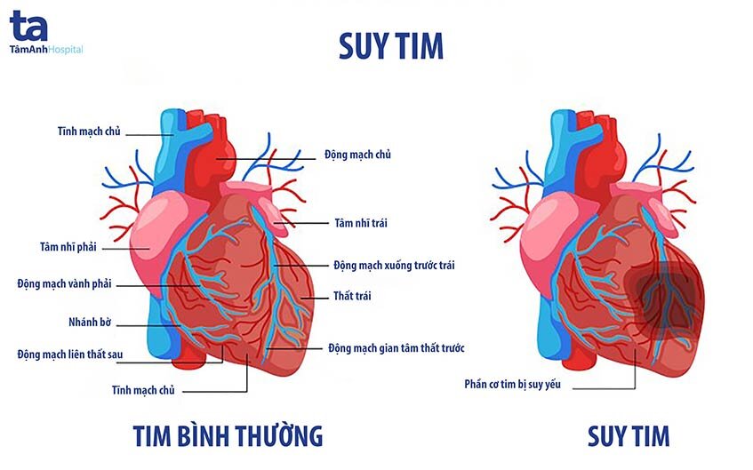 Hình ảnh trái tim bình thường và trái tim bị suy