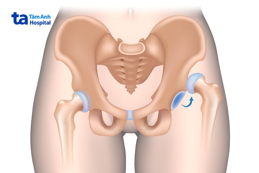 Hình ảnh trật khớp hông