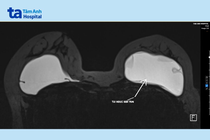 hình ảnh túi ngực bị vỡ