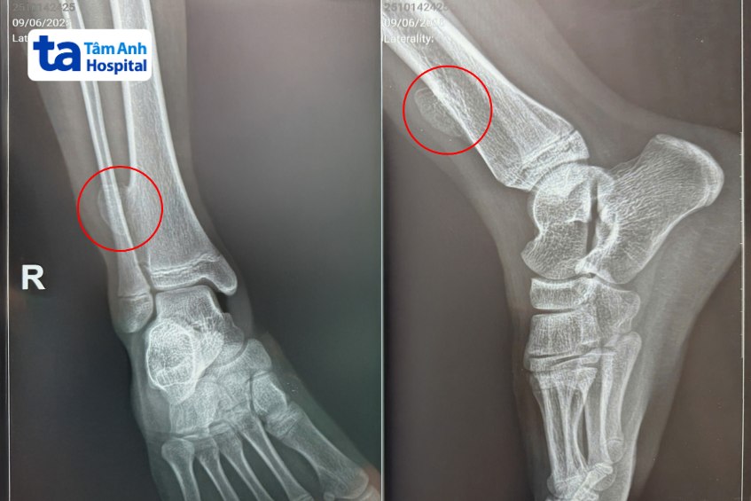 hình ảnh xquang ghi nhận bệnh nhi bị u xương sụn
