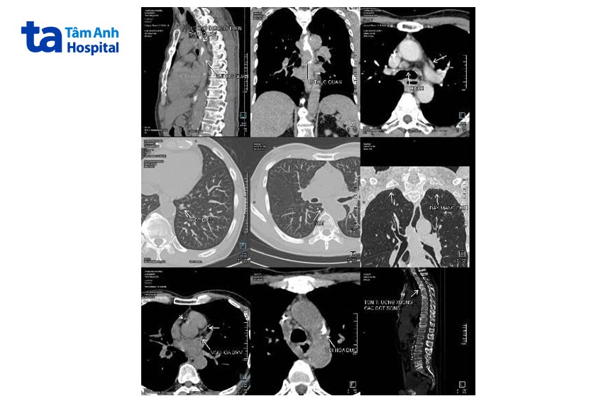 hình pet ct ung thư thực quản lan rộng sang phổi