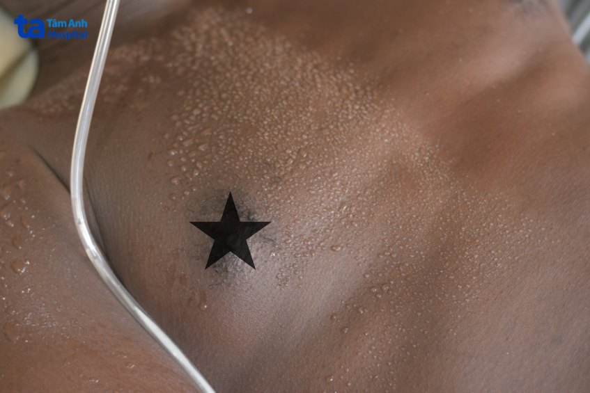 hội chứng horner đổ mồ hôi bên phải