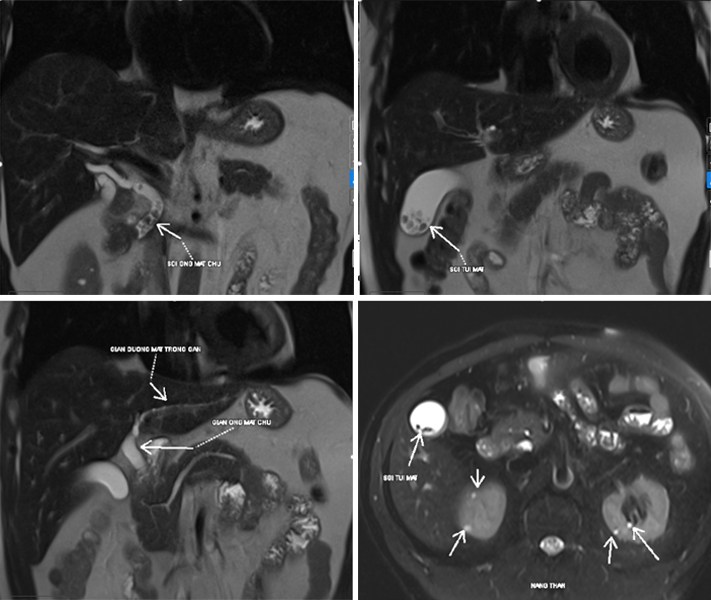kết quả mri ổ bụng phát hiện sỏi mật