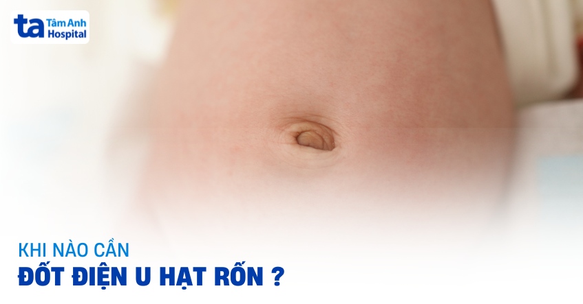 Khi nào cần đốt điện u hạt rốn ở trẻ sơ sinh? Quy trình thực hiện